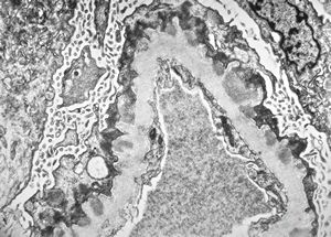 F,40y. | membranous glomerulopathy - lupus erythematodes